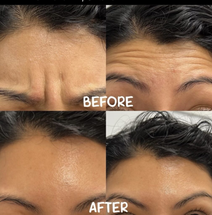 Before and after picture of forehead with and without Botox treatment