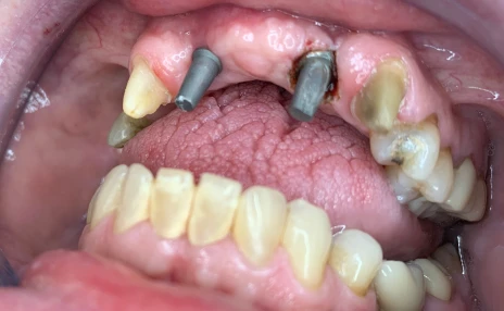 implant abutments before bridge placement